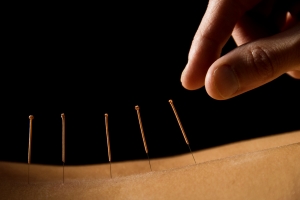 Acupunctura, terapia străveche care echilibrează energia din corp